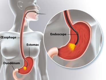 fibroscopie