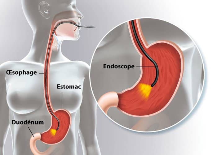 fibroscopie